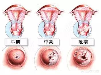 宫颈癌上身，有迹可循！出现哪3个早期症状，女性就该早做检查？