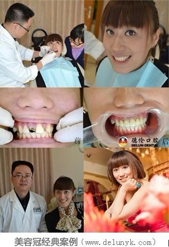 [口腔科]美容冠牙齿矫正效果怎么样好吗?