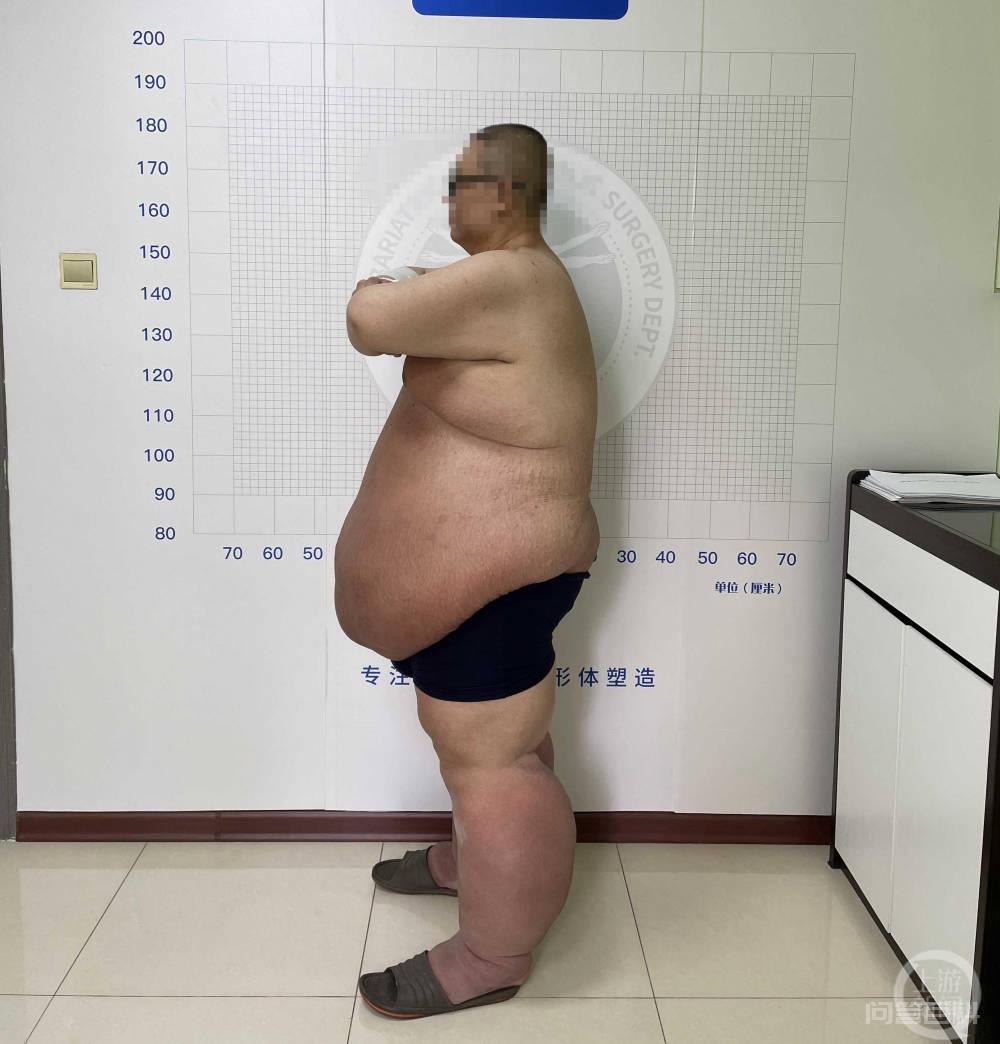 吉林480斤小伙接受治疗9天瘦了140斤，之前只能坐着<strong>睡觉</strong>