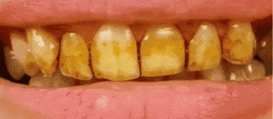 牙齿上裹层“膜”，竟能让牙齿再生，烂牙变好牙！家家都有这材料