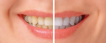流言揭秘：牙齿的颜色，越白越健康？