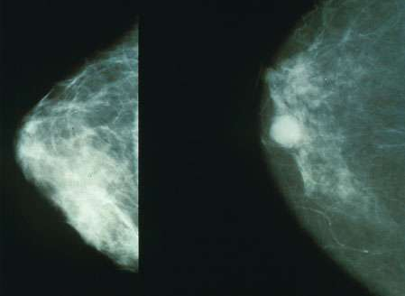 PM2.5增加了女性患乳腺癌的风险