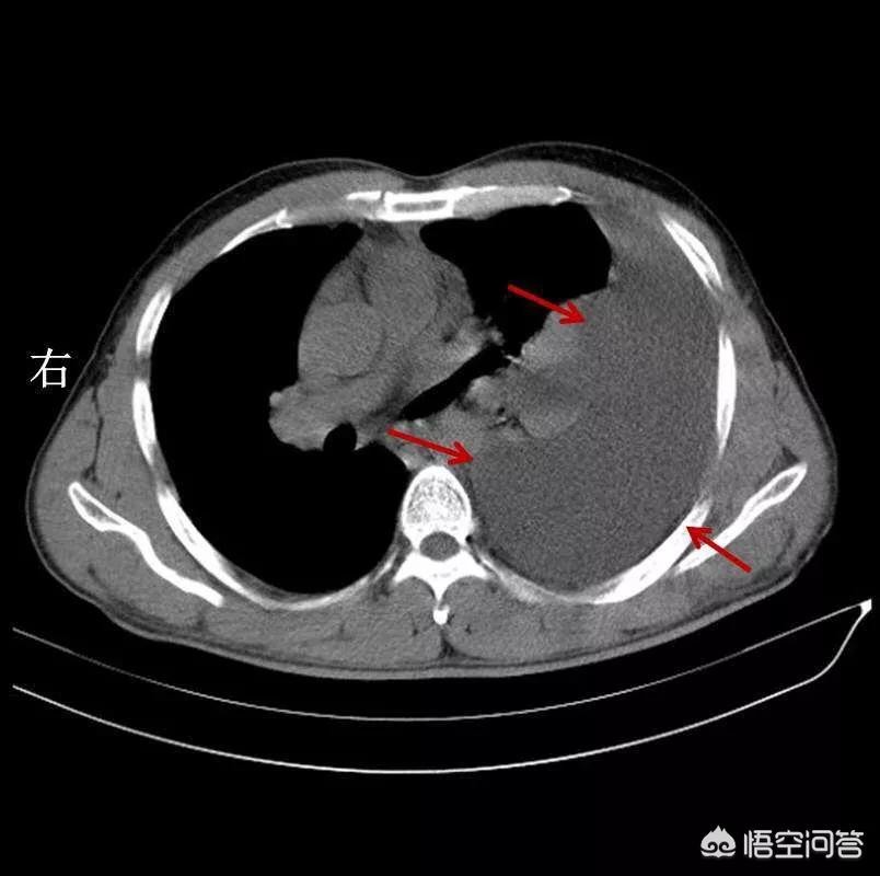  肺癌患者为什么会出现胸膜的转移？